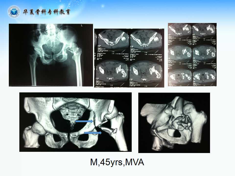 髋臼骨折手术治疗