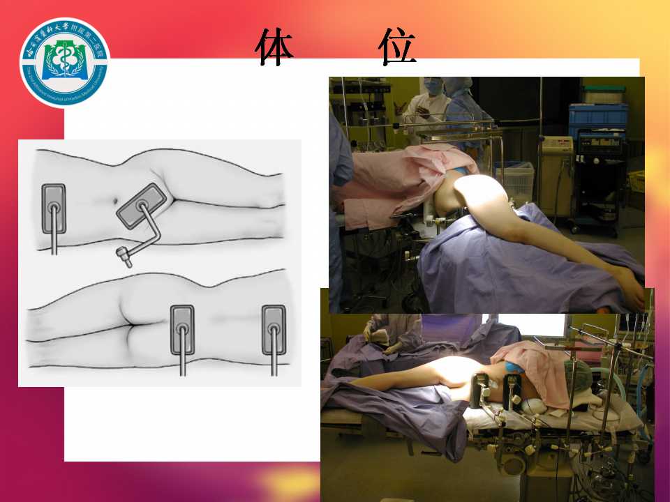 髋臼旋转截骨:手术技术与初步结果