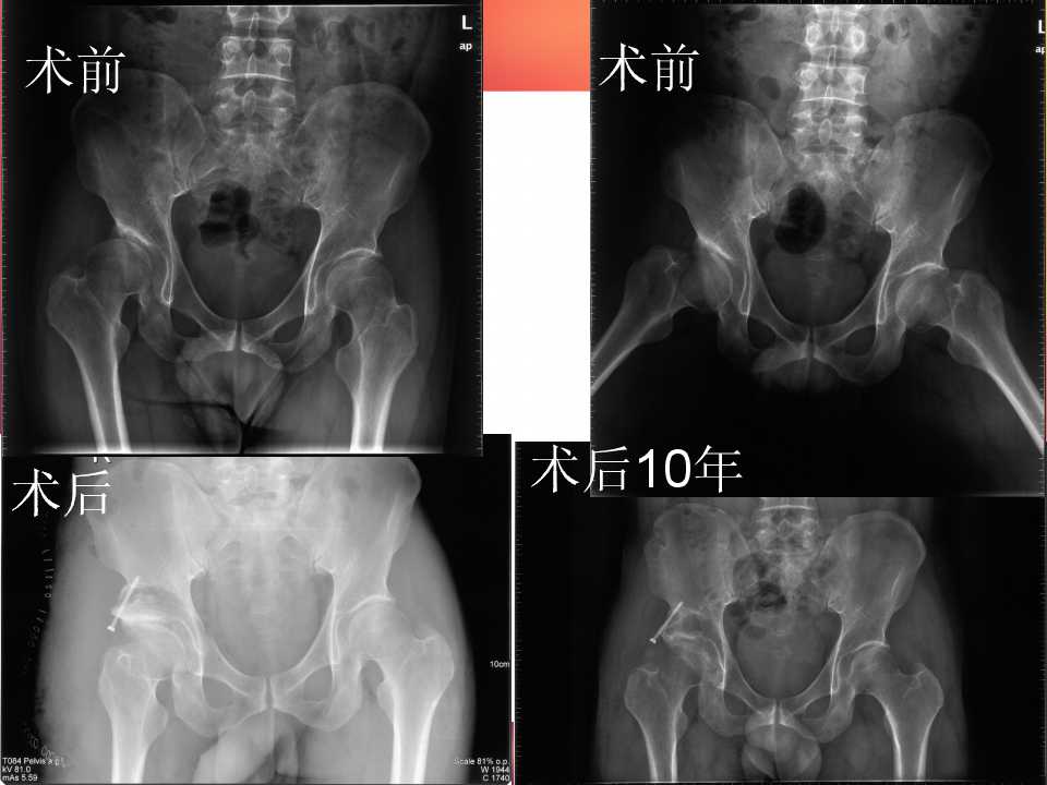 髋臼旋转截骨:手术技术与初步结果