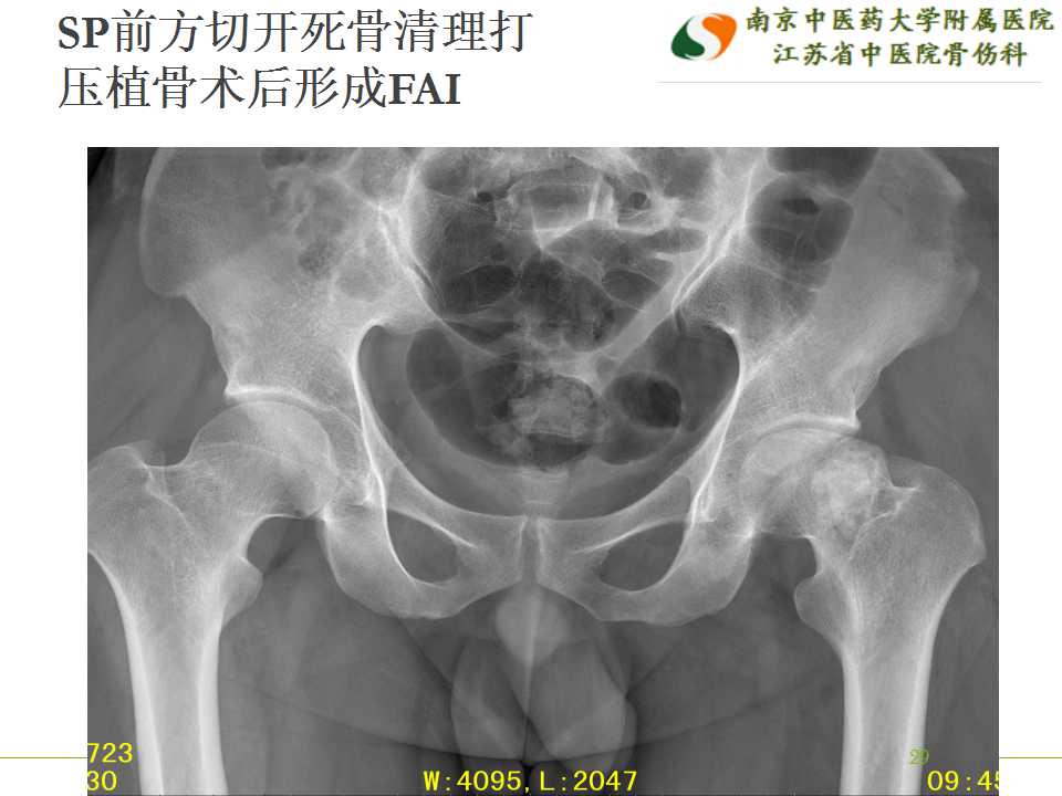 髋关节外科脱位用于治疗围塌陷期股骨头坏死治疗的初步经验