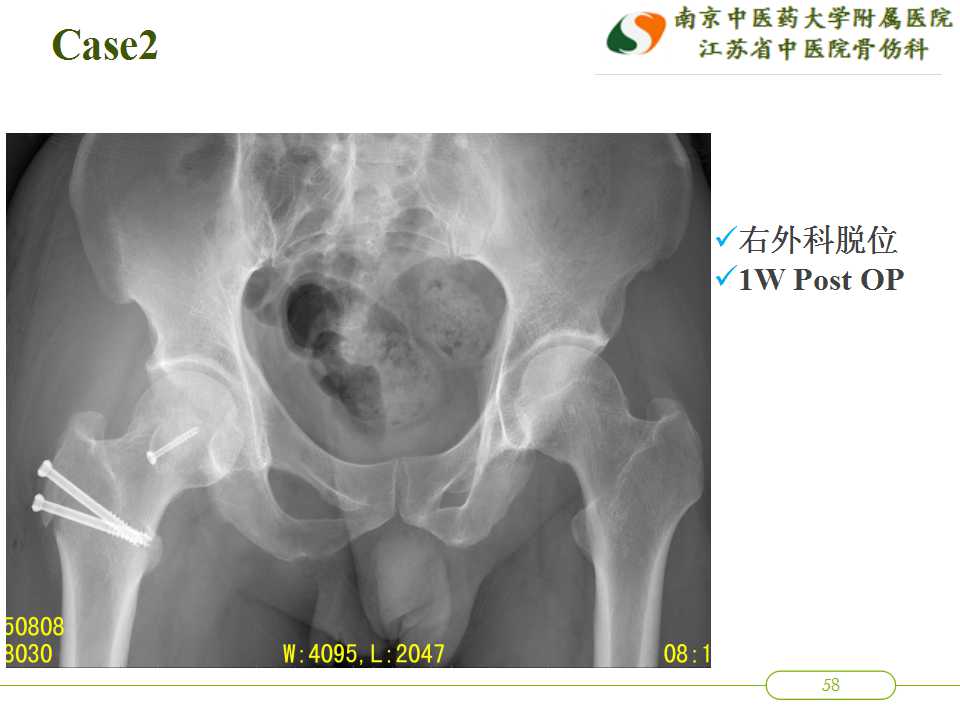 髋关节外科脱位用于治疗围塌陷期股骨头坏死治疗的初步经验