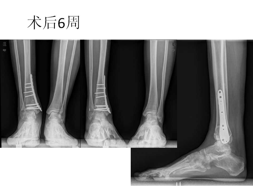 踝关节骨折畸形愈合