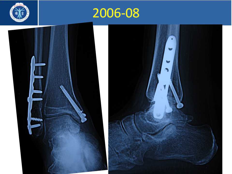 踝关节骨折畸形愈合