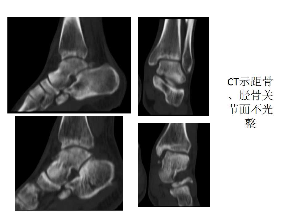 踝关节骨折畸形愈合