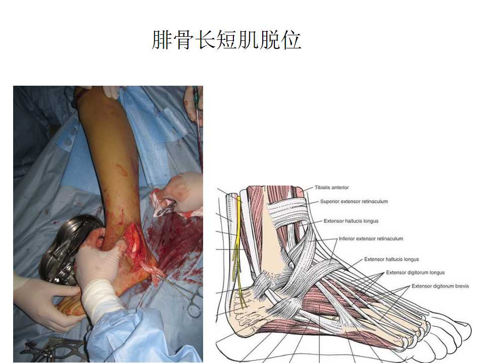踝关节骨折畸形愈合
