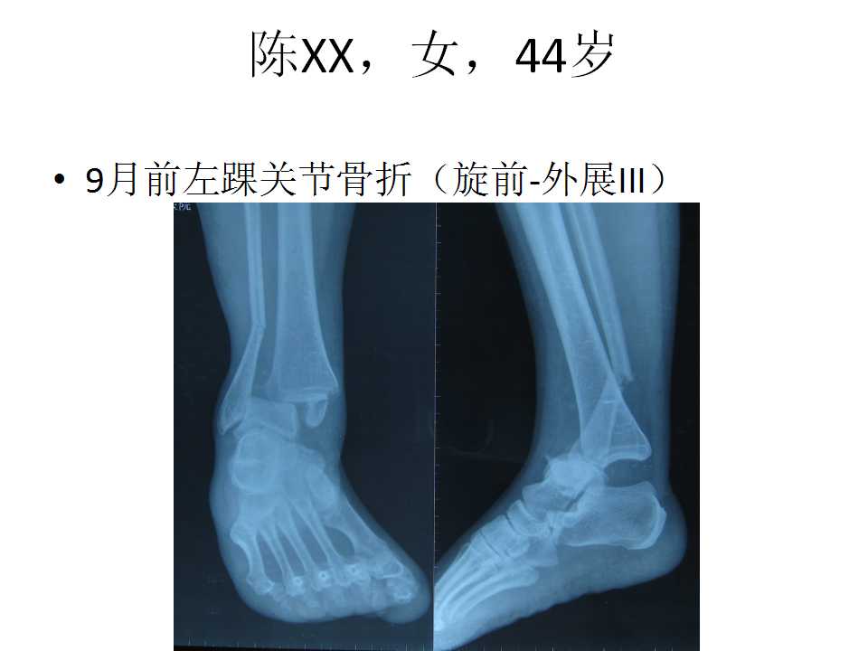 踝关节骨折畸形愈合