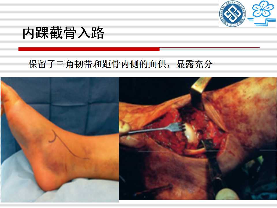 腓骨截骨入路治疗距骨骨折