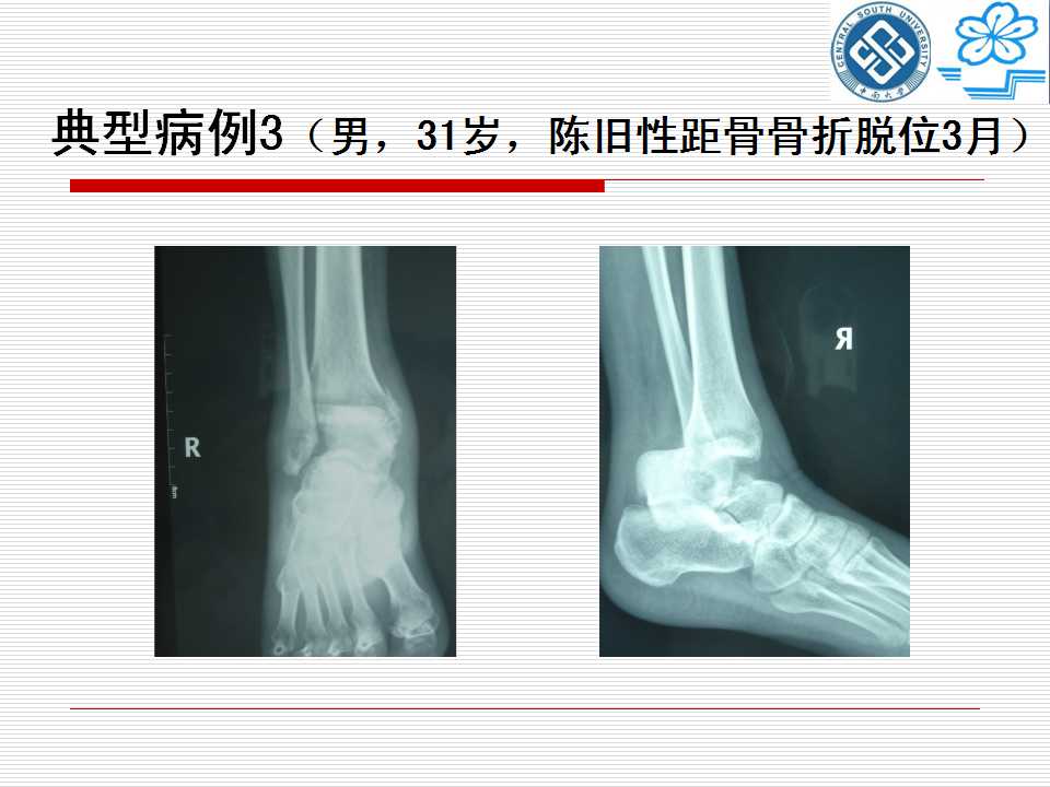 腓骨截骨入路治疗距骨骨折