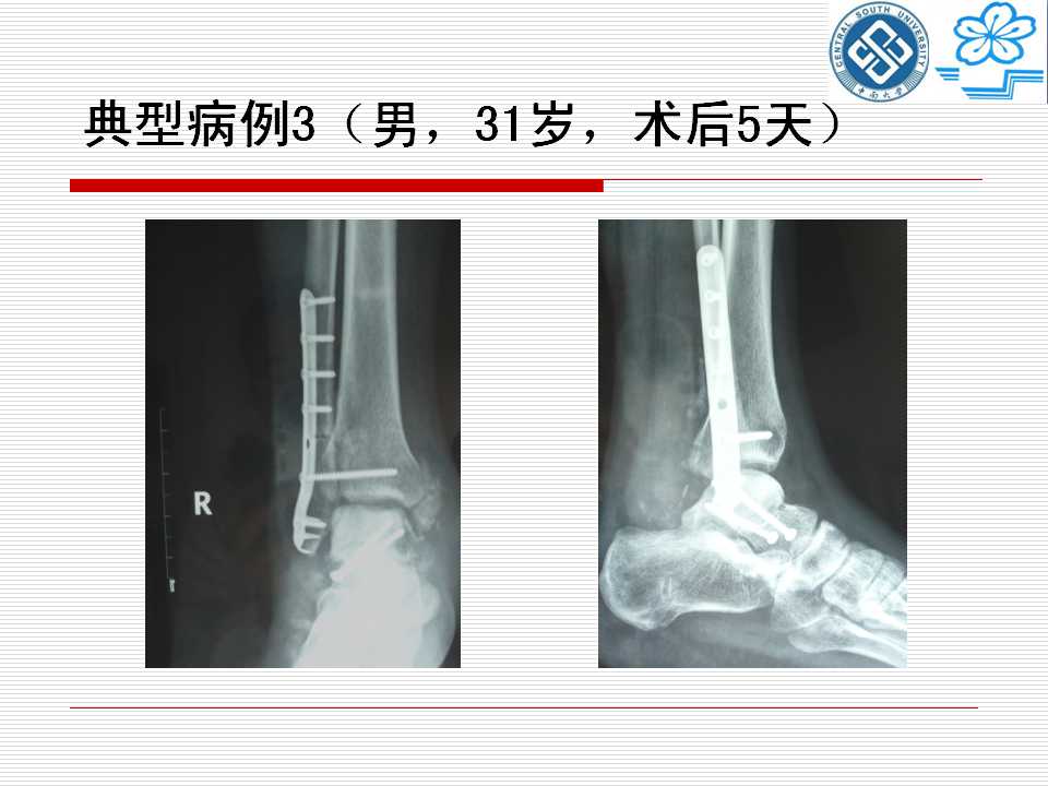 腓骨截骨入路治疗距骨骨折