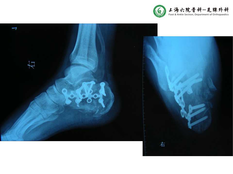 跟骨关节内骨折:内翻畸形愈合与内侧柱稳定性