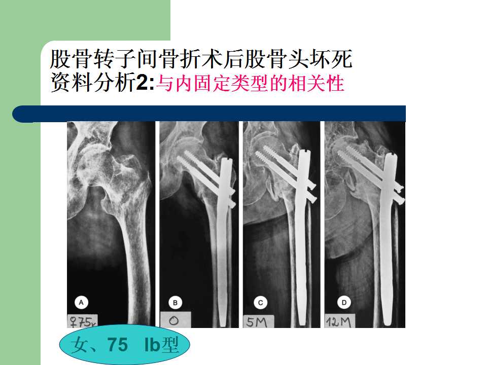老年股骨转子间骨折内固定术后股骨头坏死的临床分析