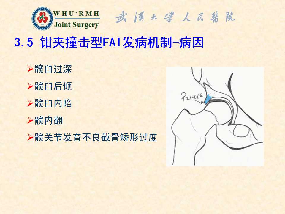 股骨髋臼撞击综合症的病理基础与诊断