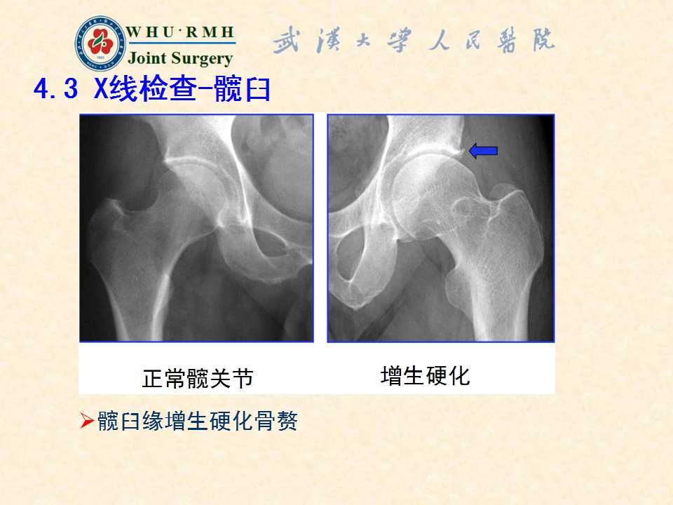 股骨和(或)髋臼解剖学异常,在髋关节运动终末期发生股骨近端和髋臼