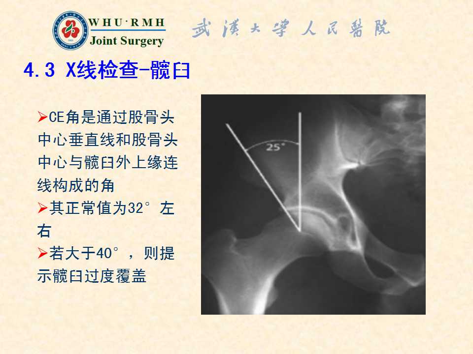 股骨髋臼撞击综合症的病理基础与诊断