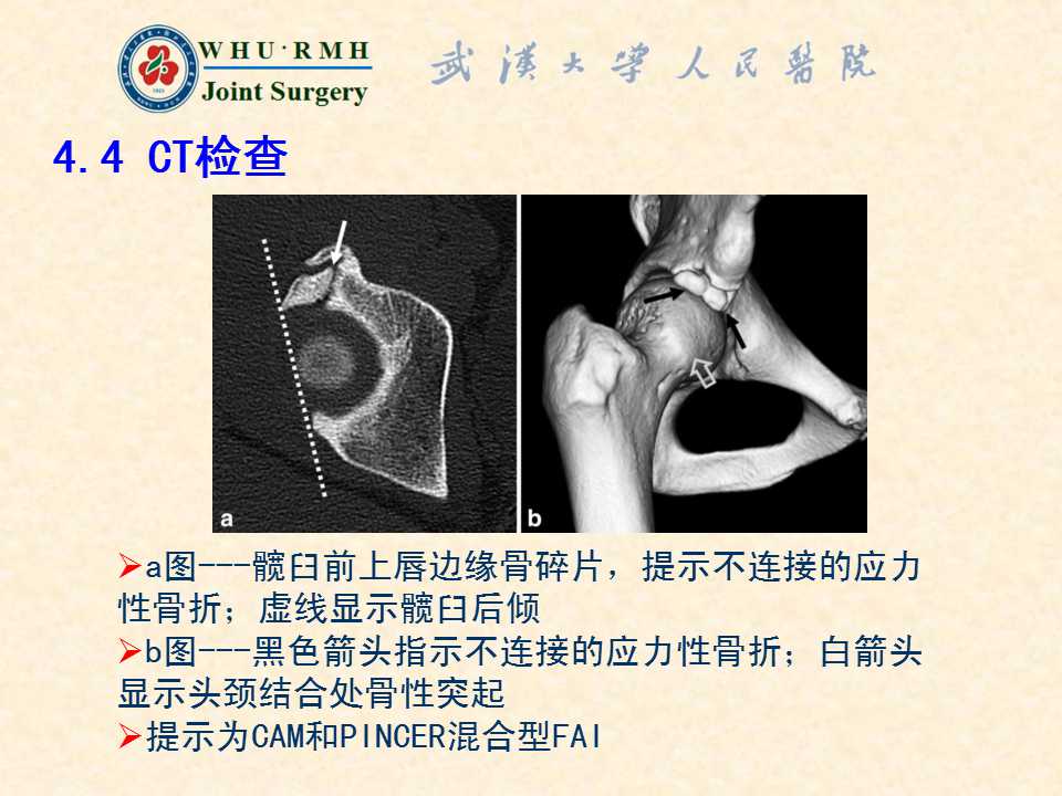 股骨髋臼撞击综合症的病理基础与诊断