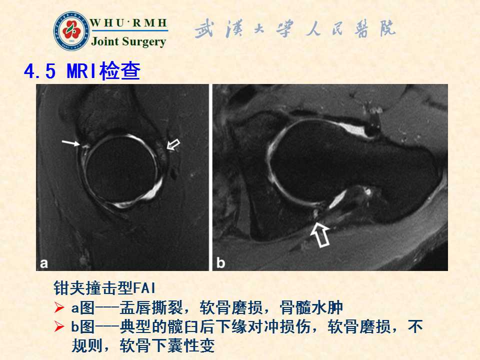 股骨髋臼撞击综合症的病理基础与诊断