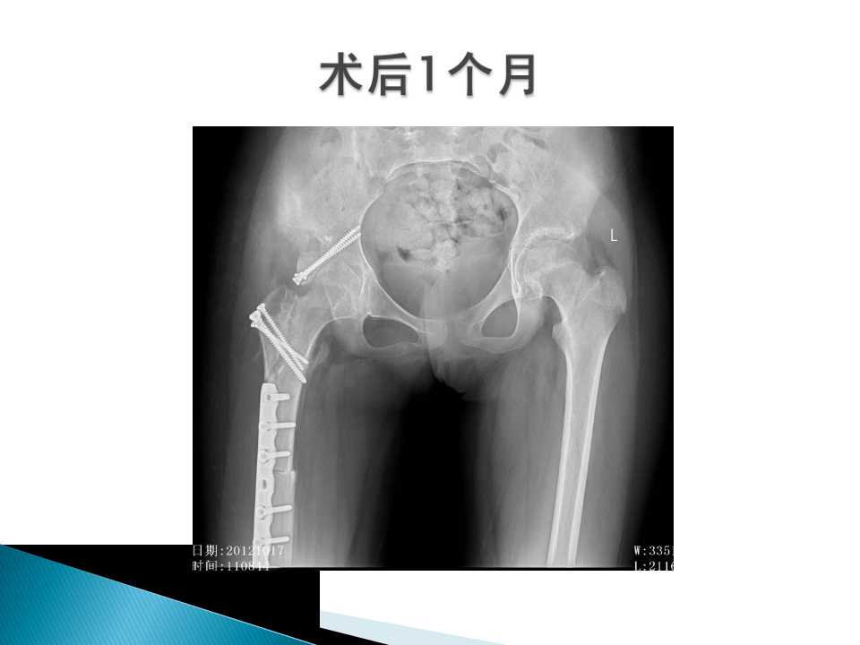 病历讨论——发育性髋关节发育不良