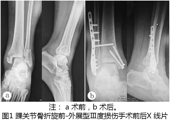 踝关节骨折手术入路及复位固定顺序的研究