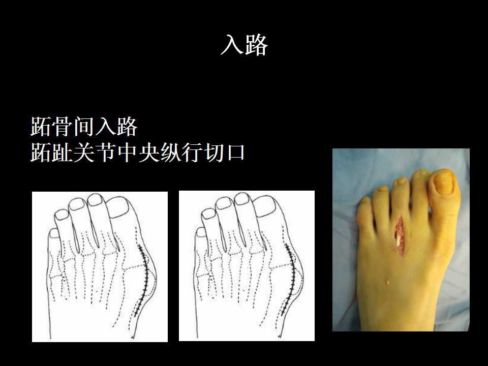 跖趾关节置换手术适应症及技巧