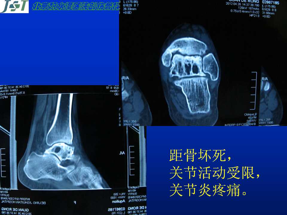 人工踝关节置换的并发症及处理