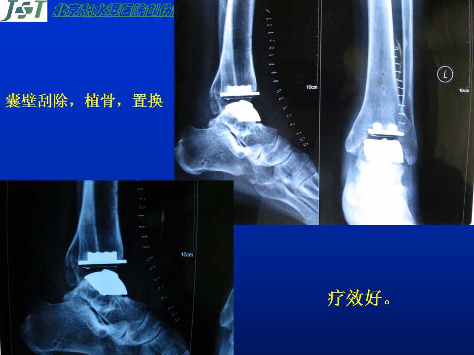 人工踝关节置换的并发症及处理