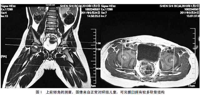 软骨性髋臼前倾角( caa) 测量: 由于无法准确定位髋臼中心并且mri