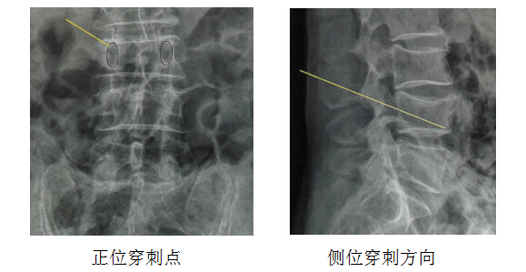 骨质疏松性椎体骨折之:治疗篇 好大夫在线