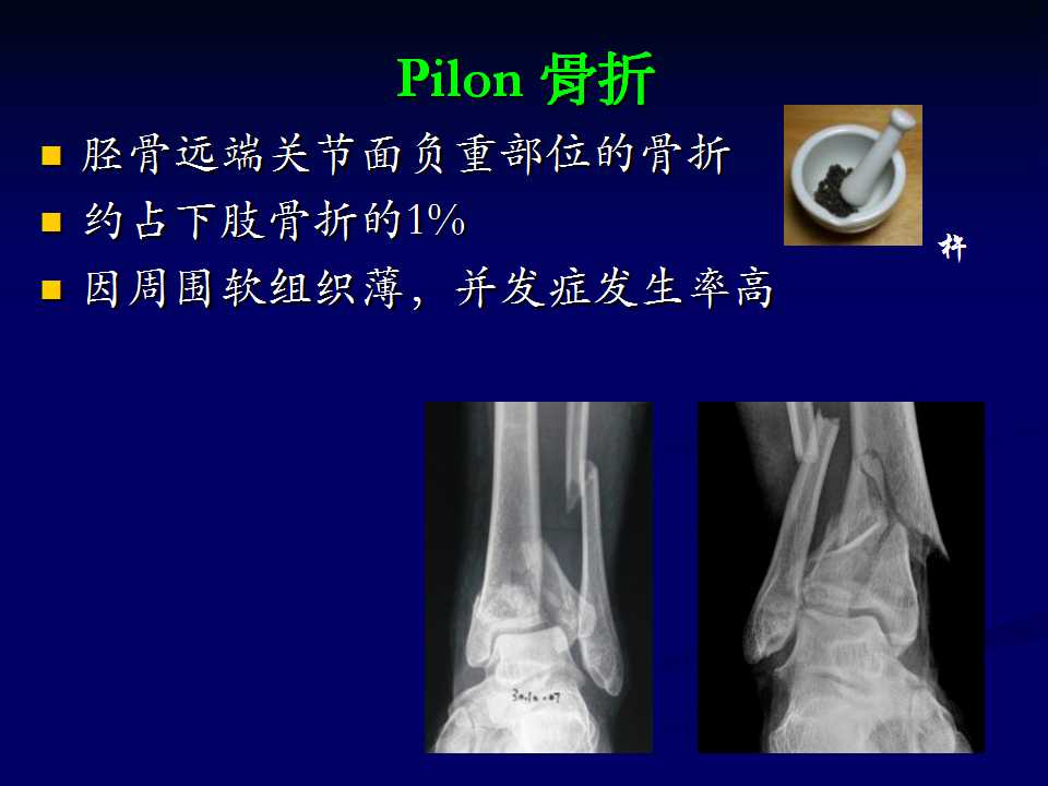 pilon骨折的手术治疗策略