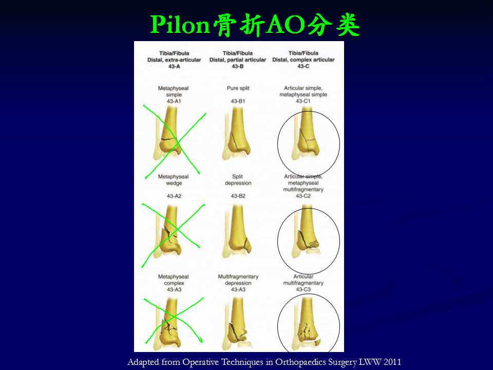 pilon骨折的手术治疗策略