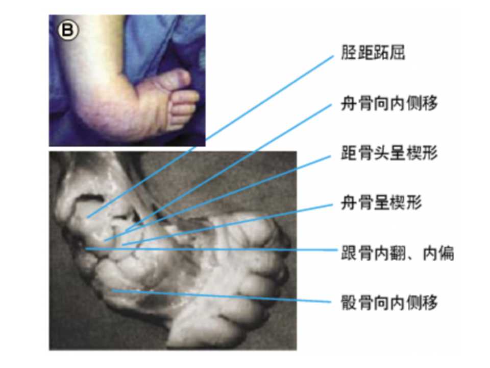 先天性马蹄内翻足早期治疗