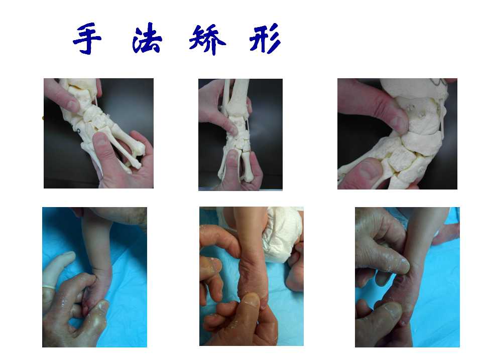 先天性马蹄内翻足早期治疗