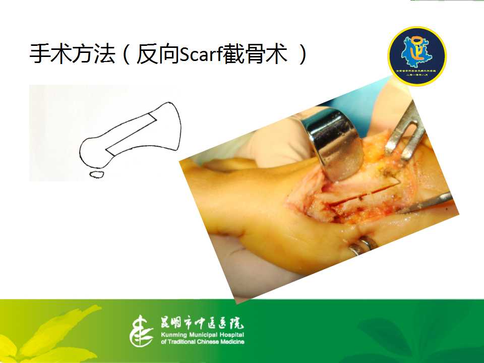 反向scarf截骨术治疗踇外翻