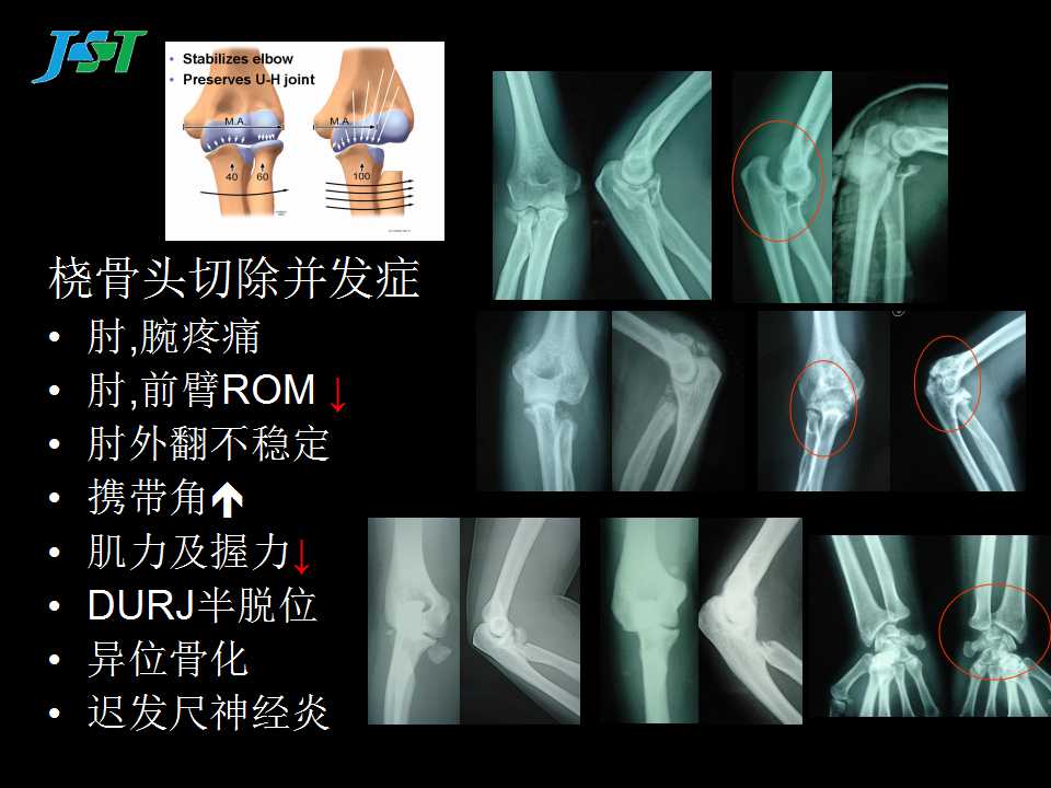 肘关节不稳定骨折