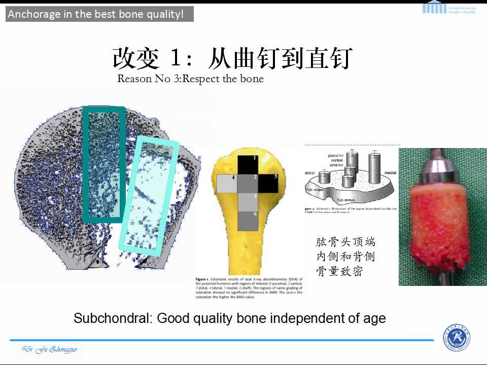 肱骨近端骨折的钢板固定与髓内钉固定的评价