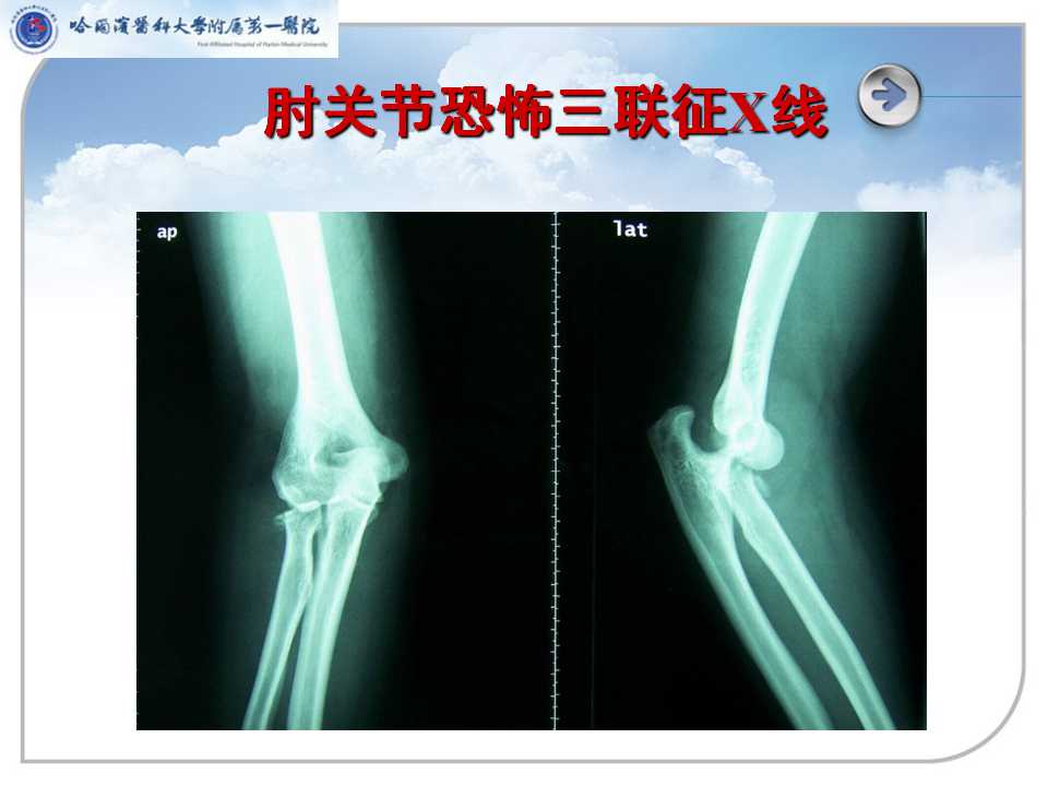 肘关节恐怖三联征围手术期康复