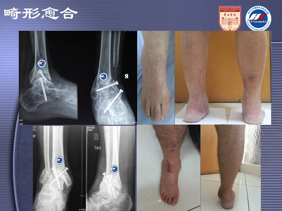 踝关节融合术的并发症