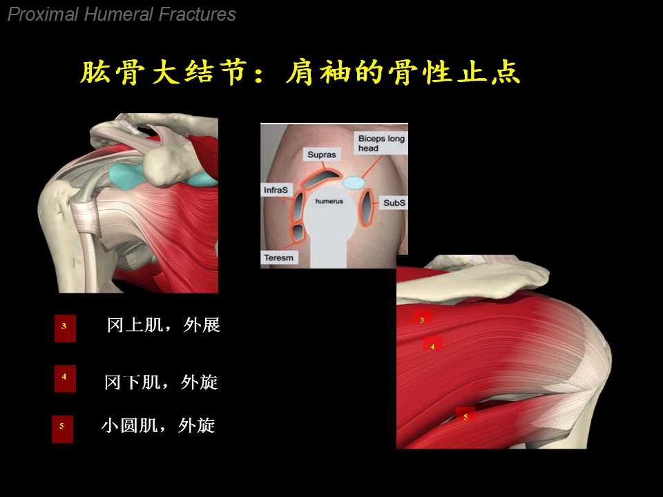 肱骨大结节骨折典型的移位方向是向上方和/或后方移位,但也有一部分