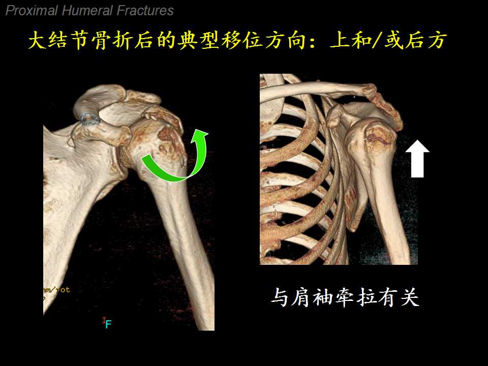 向下方移位的大结节骨折临床意义探讨