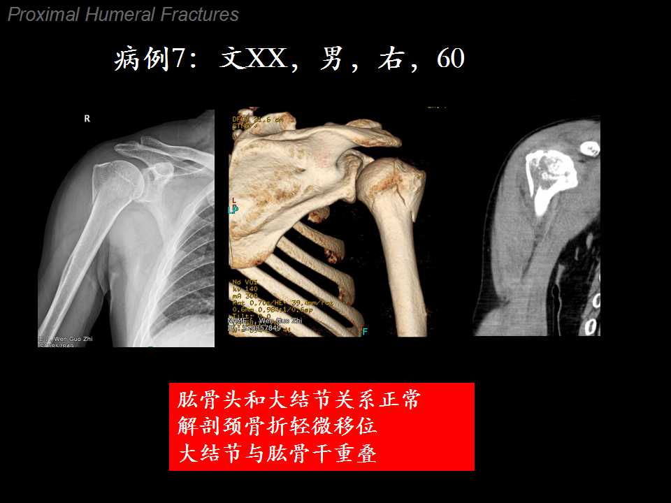 肱骨大结节骨折典型的移位方向是向上方和/或后方移位,但也有一部分