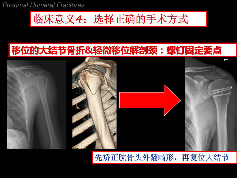 肱骨大结节骨折典型的移位方向是向上方和/或后方移位,但也有一部分