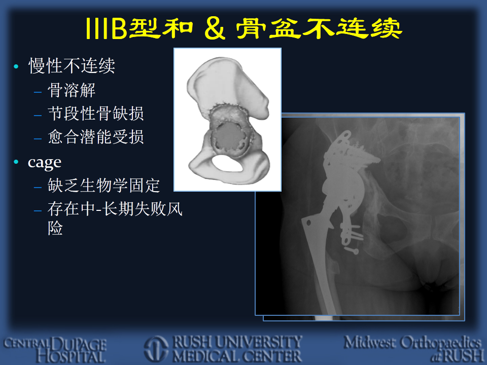 髋臼翻修和假体选择原理