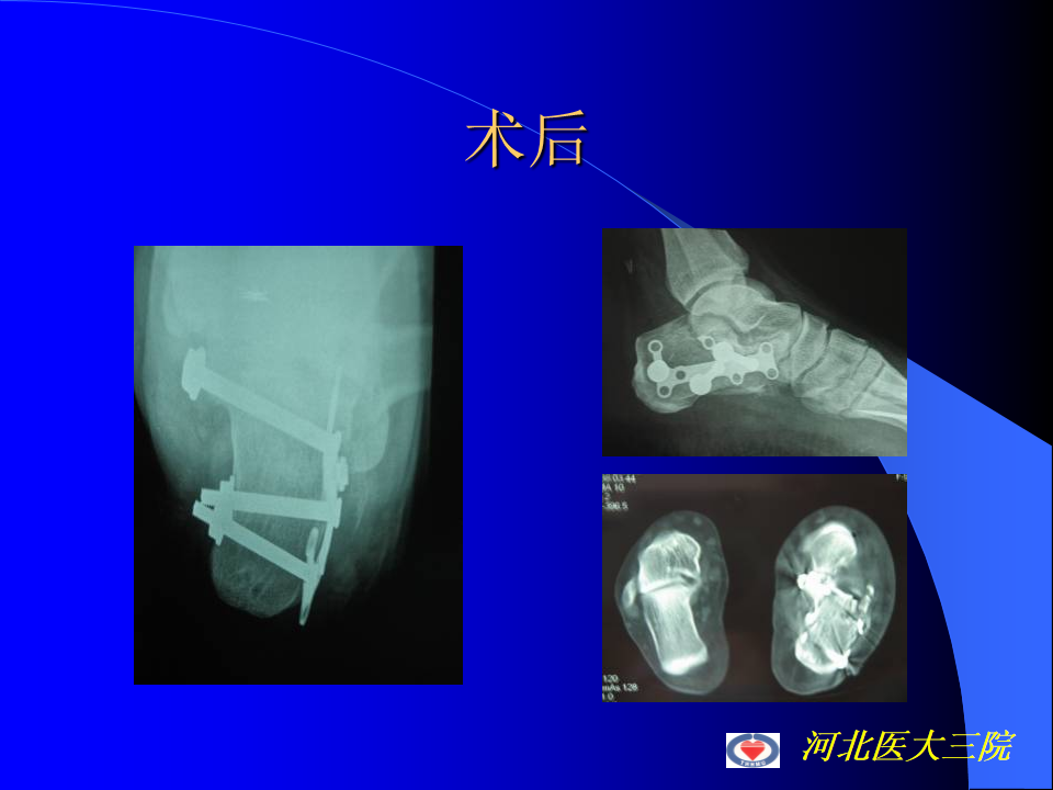 微创钢板内固定治疗跟骨骨折