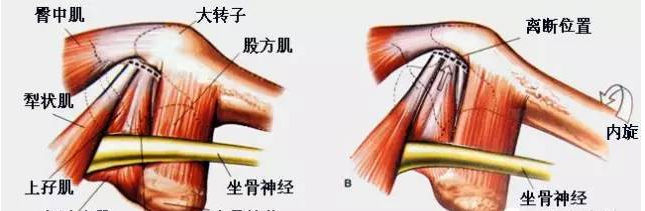 图文详解丨髋关节手术常用的3种入路