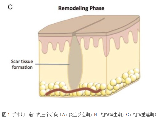 精细化管理结合个体化治疗对痔手术并发症的影响