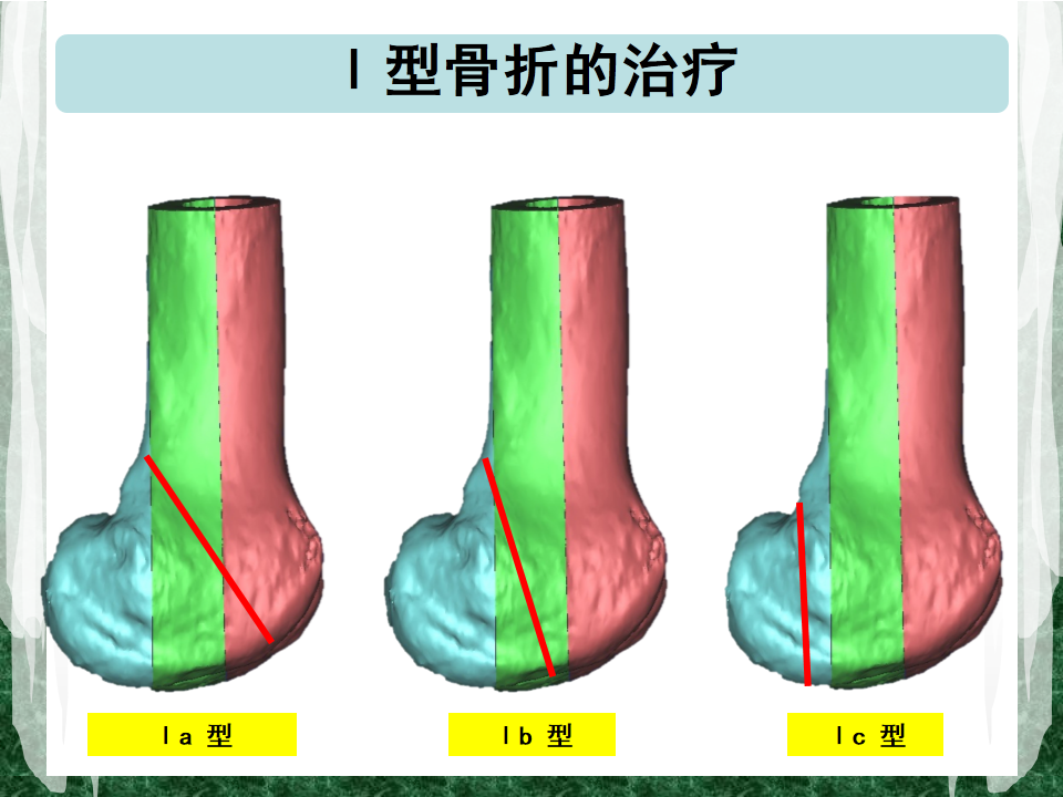 hoffa骨折的ct分型和手术治疗