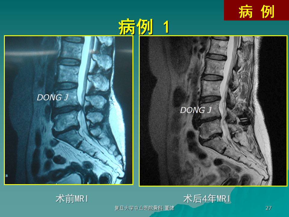 wallis治疗多节段腰椎退变性疾病的中期效果分析