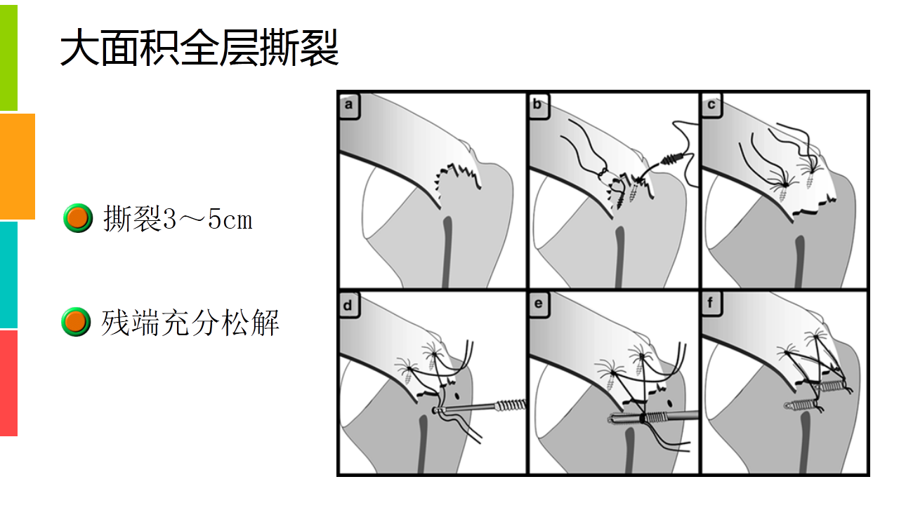 巨大肩袖撕裂的治疗策略