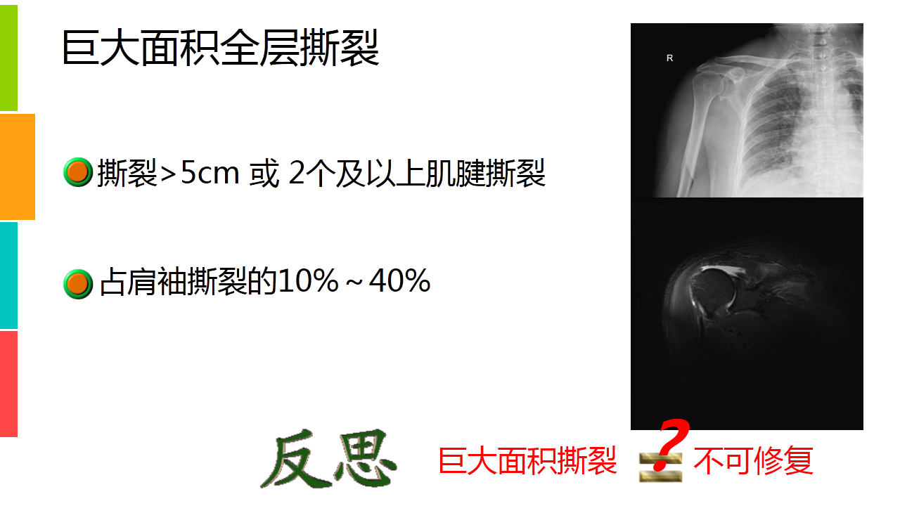 巨大肩袖撕裂的治疗策略