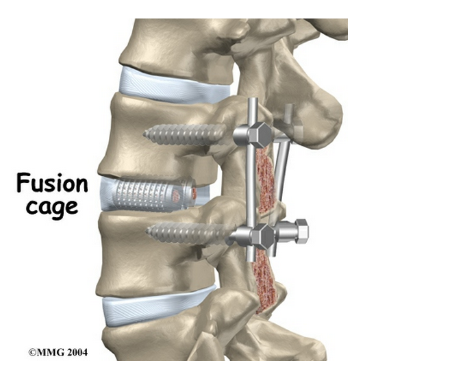 但一些研究认为:脊柱融合术虽然在放射学上取得了融合率的改善,患者的