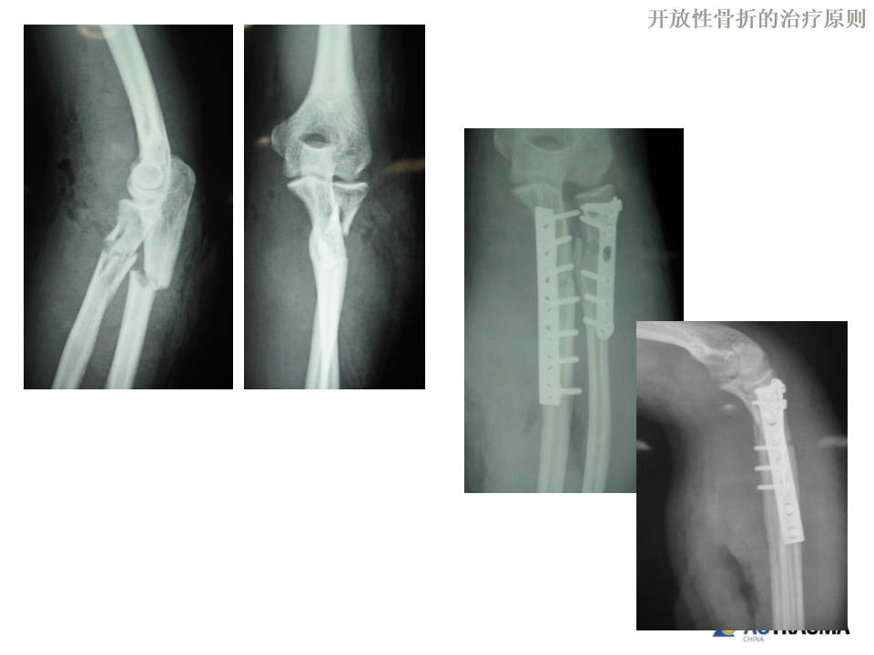 开放性骨折的处理原则